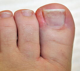 Eingewachsener Zehennagel mit Entzündung des Nagelbetts Eingewachsener Zehennagel mit Entzündung des Nagelbetts
