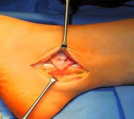 Vertiefung der Gleitrinne zur Wiederherstellung einer knöchernen Führung der Peronealsehnen.