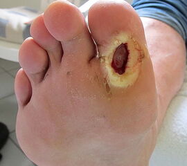 Ulkus unter der großen Zehe