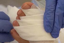 Verband nach Hallux valgus Operationen Zuerst wird ein ca. 10 cm langes Stück Tape längs v-förmig eingerissen. Die Basis des V wird am Fußrücken festgeklebt, die beiden 1 cm breiten Schenkel werden zur Fußsohle geführt.