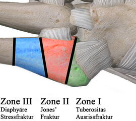 Illustration der Lawrence und Botte Klassifikation:<br>
Zone I: Avulsionsfraktur der Tuberositas <br>
Zone II: Jones’ Fraktur <br>
Zone III: Diaphysäre Stressfraktur<br>