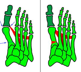 Einfluß von Korrekturen des MT I- Schaftes auf die Stellung des MTP I (Hefti ,1998)