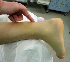 Tast- und sichtbare Dehiszenz nach frischer Achillessehnenruptur