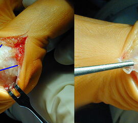 mediale Kapselplastik (V-Y), (eigenes Bildmaterial)