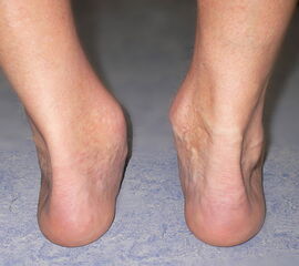Vermehrter Rückfußvalgus links bei chronischer Instabilität des Deltabandes. Die wichtigste Differenzialdiagnose ist die Insuffizienz der Tibialis posterior Sehne.