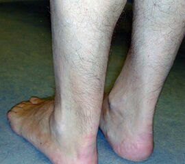 Verdickung der linken Achillessehne im mittleren Drittel bei chronischer Achillodynie.