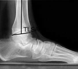 Bestimmung des supramalleolaren Alignements: TASA (a) und des TLSA (b)