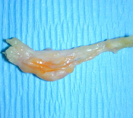 Entrapment und Pseudo-Neurom mit fibröser Hülle