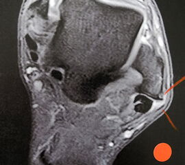 Unterbrechung des Retinakulums als indirektes Zeichen einer traumatischen Peronealsehnenluxation im MRT.