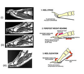 MRT Aufnahmen und Skizzen zur Demonstration des Effekts der Belastung auf den Vorfuß und das plantare Fettpolster. Dargestellt sind die verschiedenen Phasen des Gangzyklus. 
<div style="text-align:left">1. Beim Fersenaufsatz befinden sich die Zehengrundge