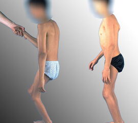 Abbildung 8: Neurogener Hackenfuß bei geführt gehfähigem Kind mit Cerebralparese (GMFCS 3): Behandlung nur der Kauerstellung mit Hüft- und Kniebeugerverlängerung führt zu weitgehender Korrektur des Hackenfußes