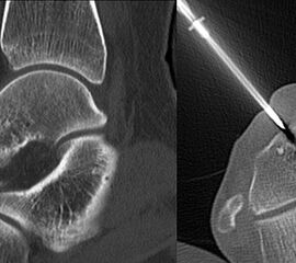 Axiale CT-Aufnahmen eines Osteoidosteoms im Bereich des Calcaneus mit typischer Nidusbildung und perifokaler Sklerose (links). Bildgesteuerte Thermofrequenzablation der Läsion (rechts).