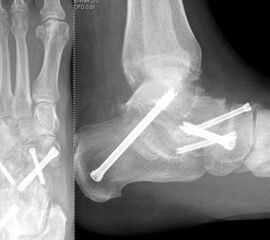 Triple-Arthrodese bei einem Pes planovalgus Grad III unter Einschluss des CC-Gelenks.