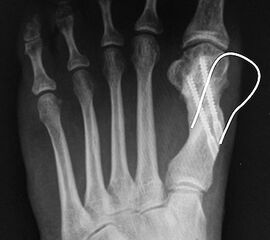Durch die Korrektur extraartikulär im Schaftbereich lassen sich auch große Intermetatarsalwinkel korrigieren.