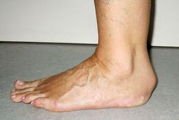 (a) Klinisches Bild einer alten ansatznahen Achillessehnenruptur rechts mit Proximalisierung des Sehnenstupfes und typischer Konturierung der Fersenregion (Foto von lateral); (b) klinisches Bild 6 Wochen nach Rekonstruktion (Foto von medial)