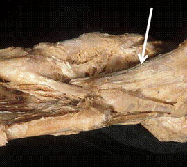 Das Ligamentum calcaneocuboideum plantare (Pfeil)