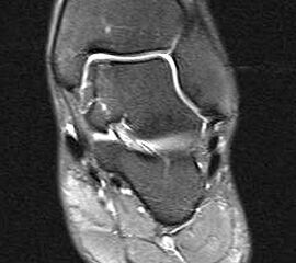 Abbildung 18: MRT 12 Monate nach Implantation einer AMIC Membran an der medialen Talusschulter. Das Knochenödem ist fast vollständig abgeklungen bei vollständiger Abdeckung der Defektzone.