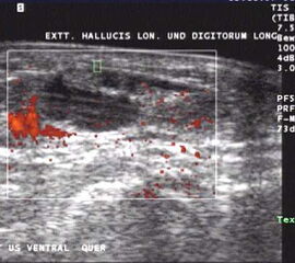 Flüssigkeit und erhöhte Gewebeperfusion im Powerdoppler sind Kennzeichen der rheumatoiden Arthritis im Ultraschall. Hier zeigt sich die Entzündung um die Extensor hallucis longus Sehne.