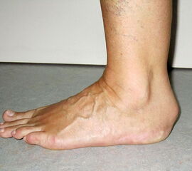 Abbildung 1: Klinisches Bild einer ausgeprägten Schwellung über dem Achillessehnenansatz bei einem Patienten mit einer Insertionstendinopathie.