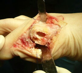 Knochenzyste MT I- Köpfchen