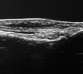Eine Tenosynovialitis, hier im Bereich des Os metatarsale I stellt sich als echoarmer Ring (Flüssigkeit) um die echoreiche Sehne dar.