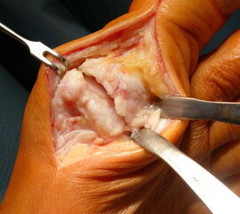 Grad 4: Wie Grad 3, aber mit Schmerzen auch in der Neutralposition der Großzehe.