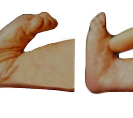 Abbildung 2: Angeborener Hackenfuß: Der Fußrücken lieget an der Schienenbeinkante an und lässt sich passiv nur bis zur Neutralstellung korrigieren. Die Korrektur tritt in den meisten Fällen ohne spezielle Therapie ein. Bei hartnäckigen Fällen helfen Korre