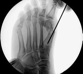 Bei entsprechender Wahl der Osteotomieebene kann auch bei minimalinvasiver Chevron-Osteotomie eine deutliche Plantarisierung des Metatarsalekopfes erreicht werden.