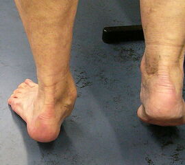 Rückansicht eines linken Pes planovalgus Stadium III beim Versuch des beidseitigen Zehenstands (selbe Patientin wie in Abb. 2). Während bei intakter Tibialis posterior Sehne rechts die Ferse physiologisch invertiert, bleibt sie auf der erkrankten