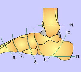 Schema der Amputationslinien im Bereich des Mittelfußes von der Seite.